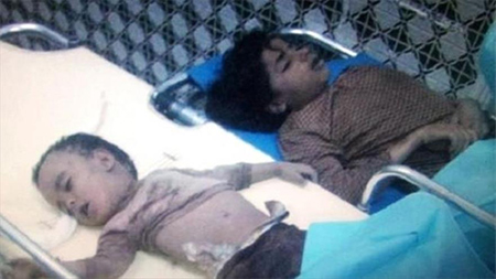 victimas de la agresión saudí contra Yemen Denuncian el uso de bombas prohibidas contra civiles en Yemen